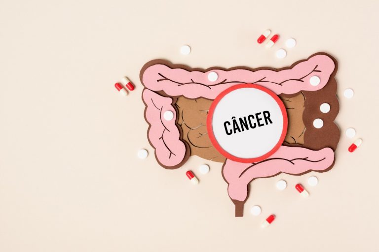 Câncer de intestino: sinais e sintomas que podem sugerir a doença