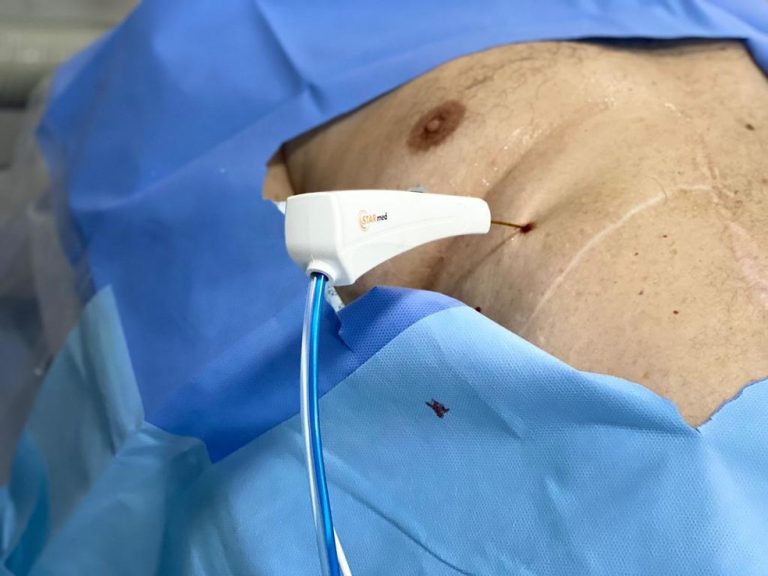 Procedimento de remoção de tumor sem cortes sendo realizado pelos médicos