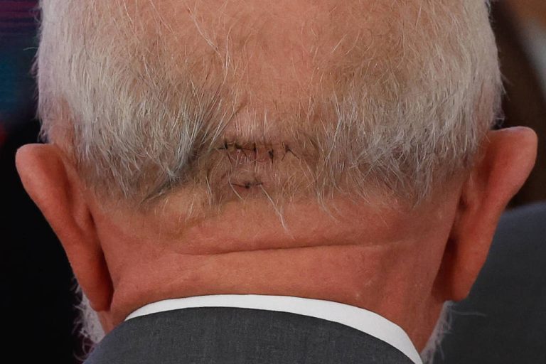 O presidente Lula passa por cirurgia de emergência na madrugada desta terça (10). Na imagem, cabeça de Lula com pontos após acidente doméstico - Gabriela Biló/ Folhapress